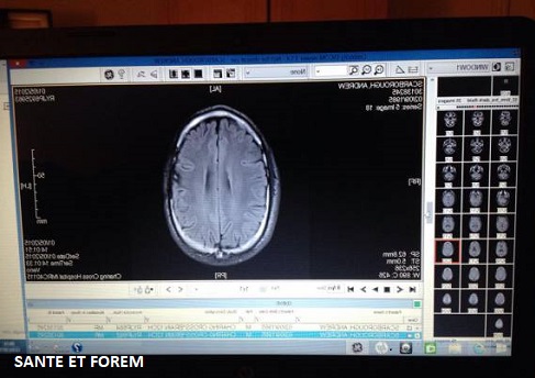 Cancer du cerveau guérison et survie avec un régime cétogène sans glucides.